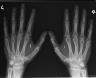 x-ray of chipped hands2.JPG